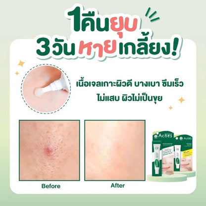 MENTHOLATUM ACNES Sealing Jell (Acne Treatment Gel) 5g. เจลแต้มสิว ยุบไวมาก