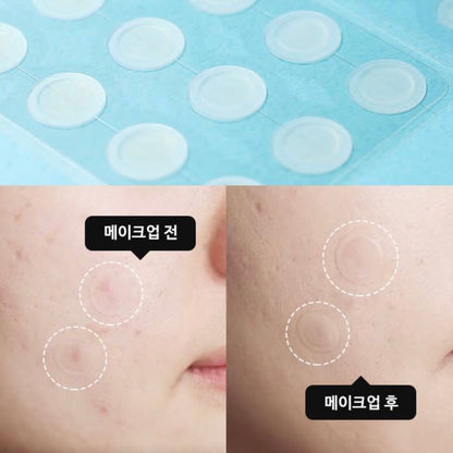 Korean Pimples Patch, Acne spot treatment sticker